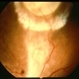 Toxocariasis Cyst
